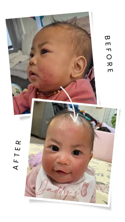 Tallow balm for baby with eczema-prone skin