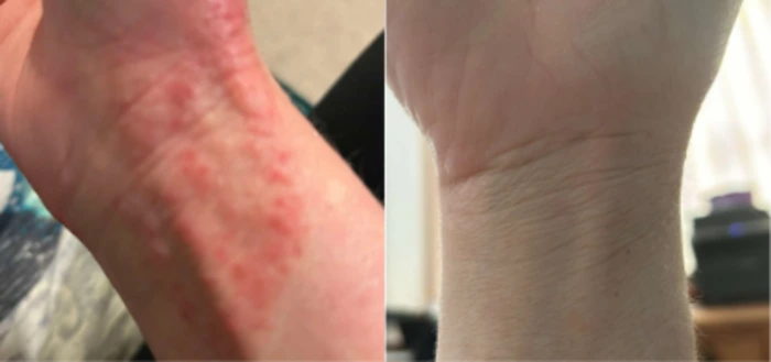 NZ customer before and after using tallow balm