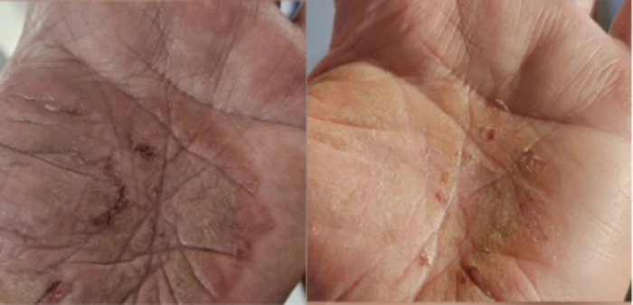 Tallow balm NZ before and after skin results
